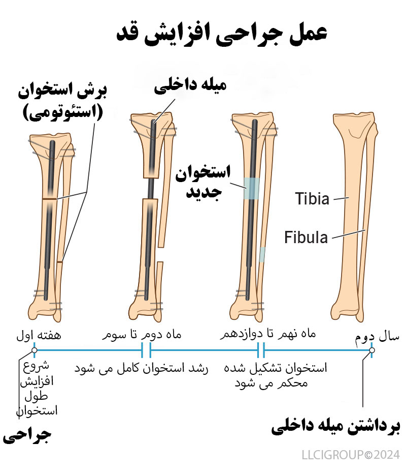 عمل جراحی افزایش قد